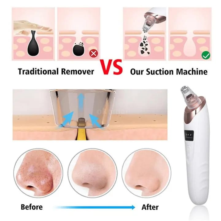 Electric Blackhead Remover – Vacuum Pore Cleaner for Deep Facial Cleansing